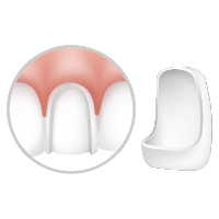 dental porcelain veneers